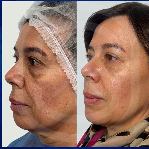 Resultado clínico 4: antes y después de Endoláser Facial
