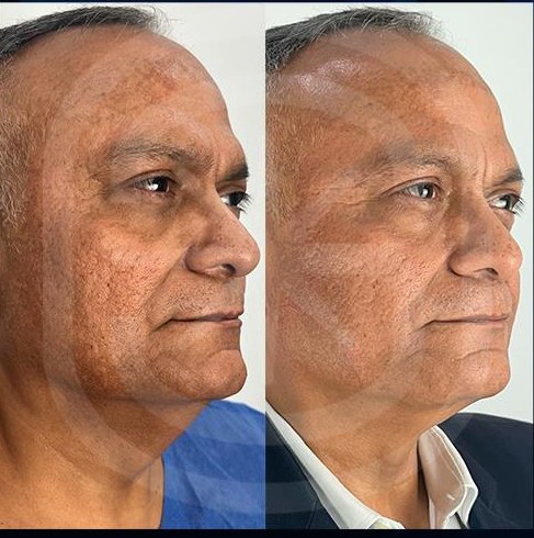 Resultado clínico 5: antes y después de Endoláser Facial