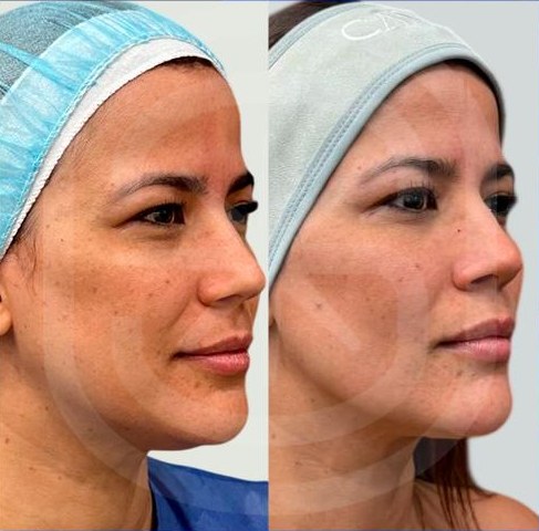 Resultado clínico 1: antes y después de Endoláser Facial