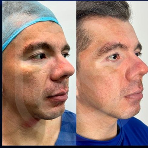 Resultado clínico 6: antes y después de Endoláser Facial
