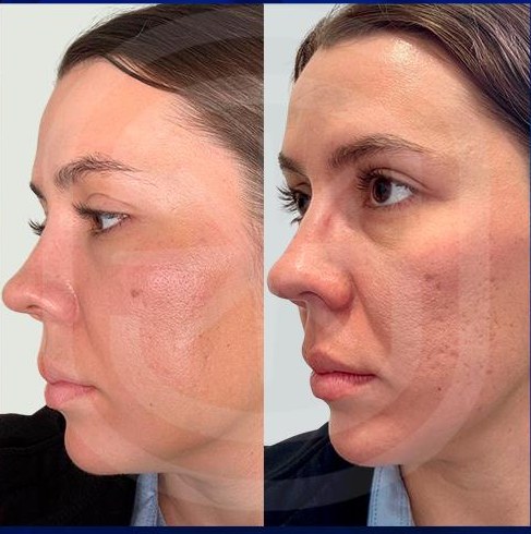 Resultado clínico 3: antes y después de Endoláser Facial