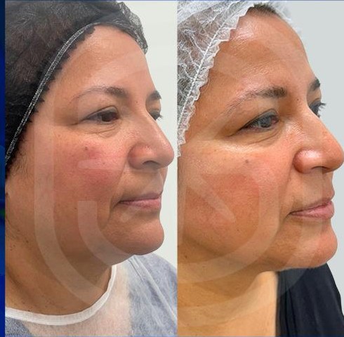 Resultado clínico 2: antes y después de Endoláser Facial